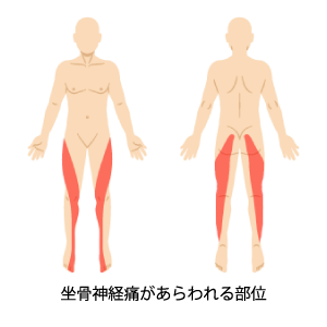 と 坐骨 は 神経痛